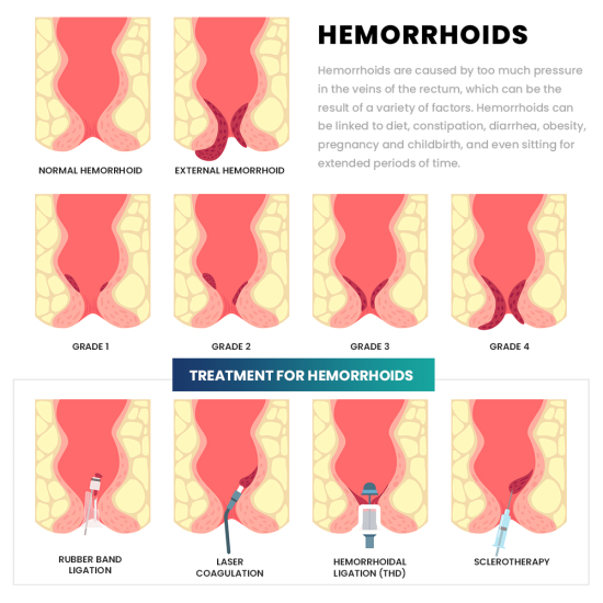 hemorroid-chart-v3